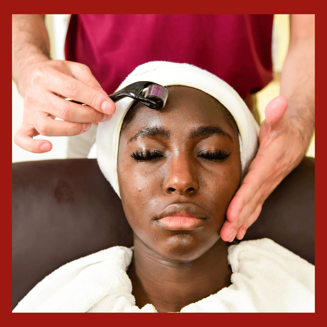 FACIAL SKIN NEEDLING ( with combination of PEELS )-0